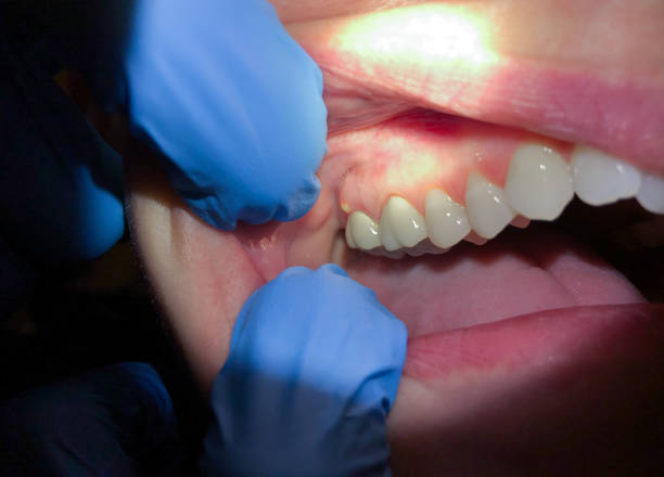 Best Emergency Wisdom Teeth Removal in Newport, VT